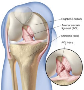 ACL Tear Treatment Box Hill