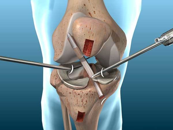 ACL Reconstruction Box Hill